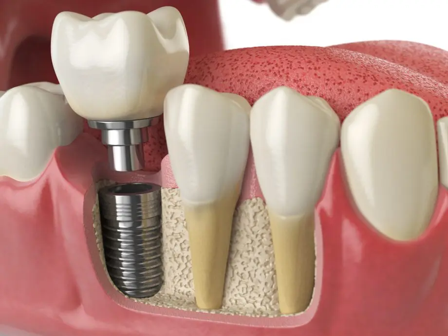 What to Expect During Your Dental Implant Procedure